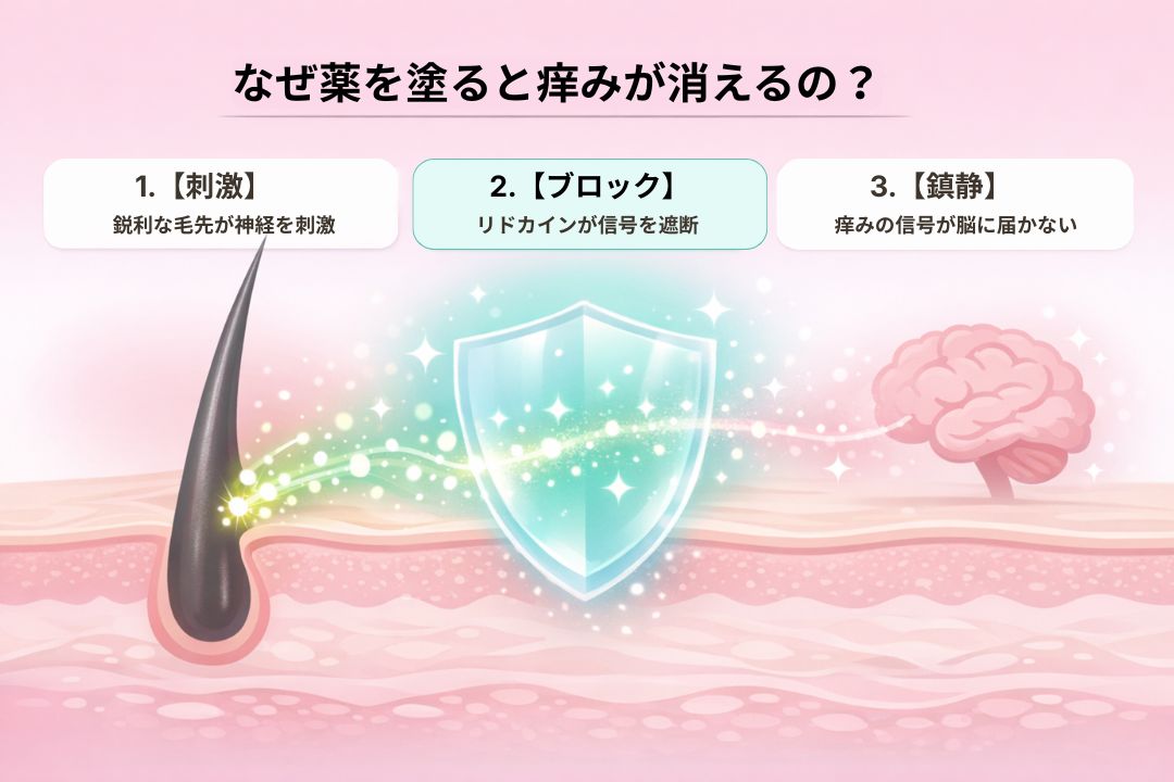 VIOの痒みを止めるリドカインの作用メカニズム図解。エンティティ「リドカイン」が「痒み・チクチク」の原因である神経信号の伝達を物理的にブロックし、不快感を即座に消失させる「原因と結果」の論理関係を視覚的に説明しています。