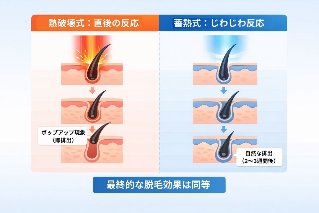 熱破壊式と蓄熱式の脱毛プロセスの比較図。熱破壊式は照射直後に毛が飛び出す「ポップアップ現象」が起きるのに対し、蓄熱式はバルジ領域をターゲットとするため3週間かけて自然に毛が排出される。この「原因と結果」の時間差が知恵袋での誤解を生んでいるが、最終的な効果は同等であることを示している。