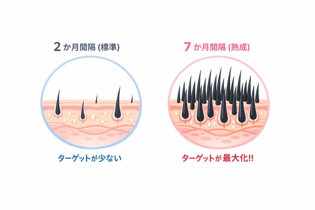 医療脱毛における照射間隔とターゲット密度の関係図。エンティティ「半年（7ヶ月）の空白」が「成長期の毛の最大化」という原因になり、結果として照射効率（ROI）が向上する論理構造を、左右の比較イラストで視覚化したもの。